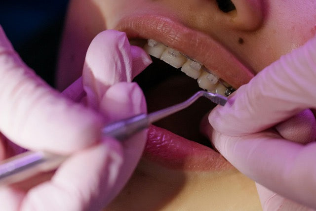 The Essential Role of Smarter Cleaner for Braces Wearers